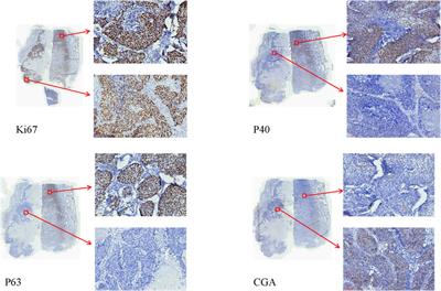 Advances in combined neuroendocrine carcinoma of lung cancer